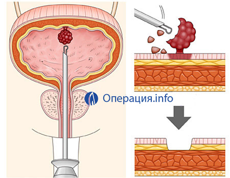 Цистотомія сечового міхура: особливості проведення операції