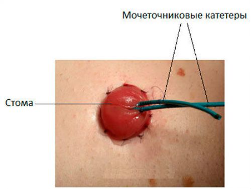 Цистотомія сечового міхура: особливості проведення операції