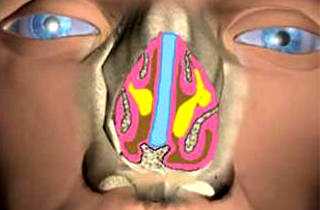 Кіста клиноподібної (основний) пазухи носа: симптоми і лікування