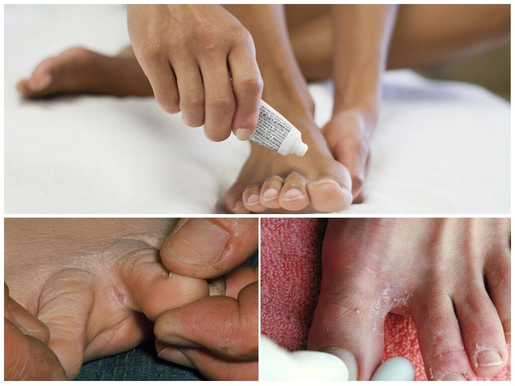 Лікування грибка між пальцями ніг народними засобами: ефективні способи