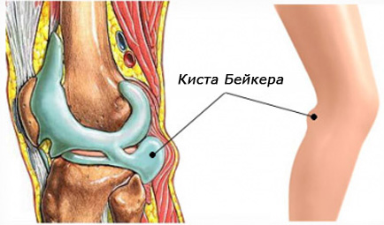 Лікування кісти Бейкера колінного суглоба в домашніх умовах народними засобами