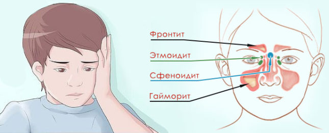 Методи лікування катарального гаймориту