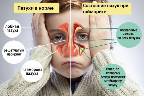 Може бути гайморит без нежиті і виділень з носа?