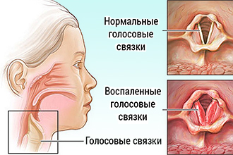 Інгаляції при ларингіті небулайзером – які препарати потрібні?