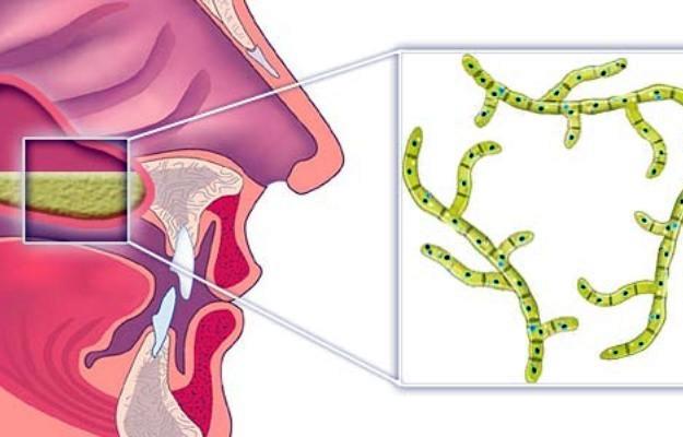Освіта грибкового гаймориту в порожнині носа. Методи лікування Освіта грибкового гаймориту в порожнині носа. Методи лікування
