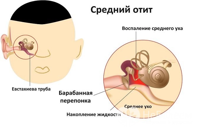 Отит – основна причина болю у вусі. Симптоми, можливі ускладнення та лікування отиту.