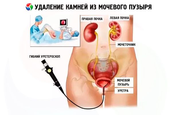 Підготовка та проведення цистоскопії уретри і сечового міхура