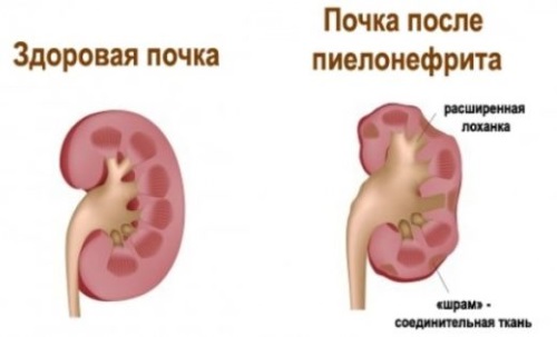 Пієлонефрит з температурою що робити