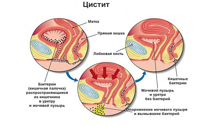 Після сечовипускання капає сеча (у чоловіків, дітей, жінок): причини, діагностика, лікування (препарати, вправи, операція), гігієна, профілактика