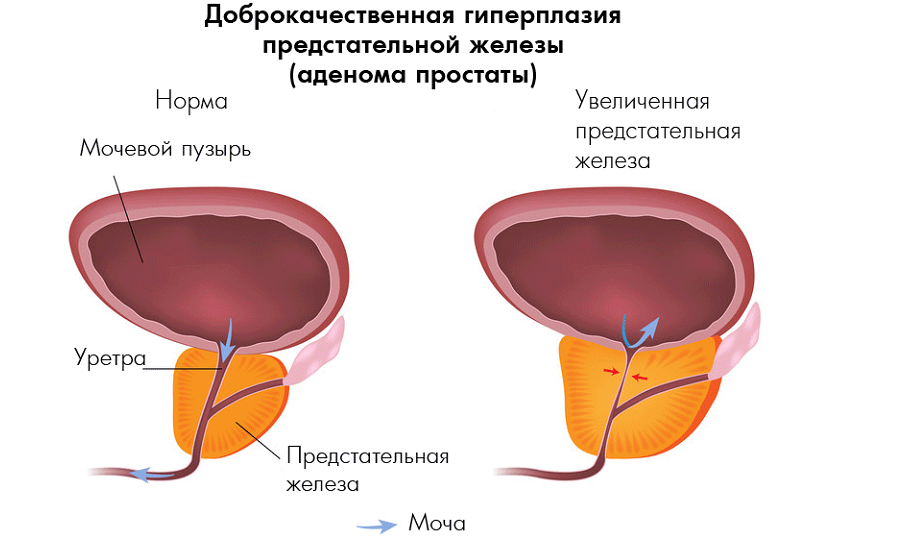 Після сечовипускання капає сеча (у чоловіків, дітей, жінок): причини, діагностика, лікування (препарати, вправи, операція), гігієна, профілактика