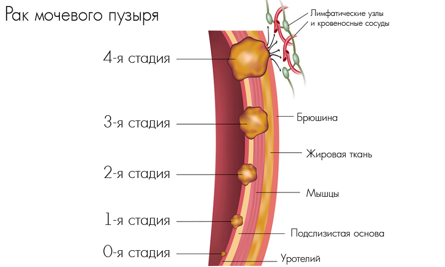 Після сечовипускання капає сеча (у чоловіків, дітей, жінок): причини, діагностика, лікування (препарати, вправи, операція), гігієна, профілактика