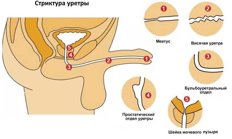 Після сечовипускання капає сеча (у чоловіків, дітей, жінок): причини, діагностика, лікування (препарати, вправи, операція), гігієна, профілактика