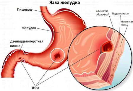 Печія в горлі – причини і лікування