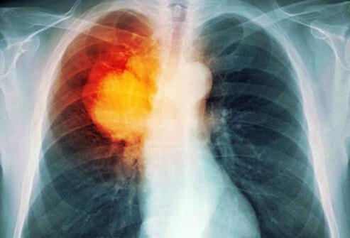 Передраковий стан легенів. Хвороби легенів: класифікація та перші ознаки Часті захворювання легень