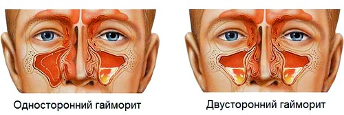 Перші ознаки гаймориту і на що звернути увагу