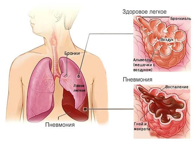 Перші ознаки пневмонії у дітей як виявити вчасно