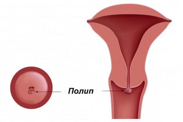 Поліп ендометрію і вагітність – сумісність, після видалення