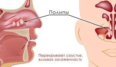 Поліпи носа гайморит – Хвороби носа
