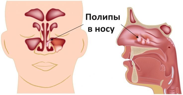 Поліпи носа гайморит – Хвороби носа
