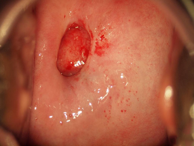 Поліпи в матці — що це таке