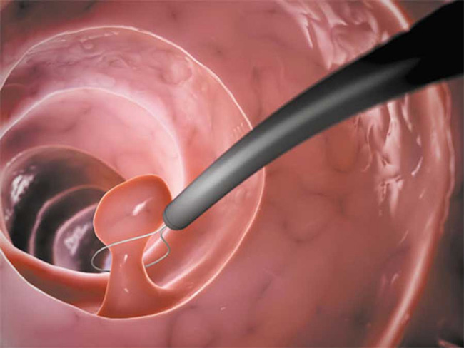 Поліпи в матці — що це таке