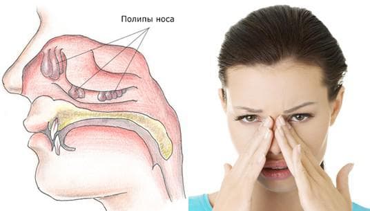 Поліпи в носі лікування без операції Лікування поліпа в носі народними засобами