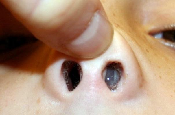 Поліпи в носі у дитини симптоми і лікування