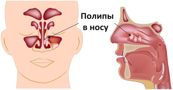 Поліпи в носі у дорослих: причини, симптоми і методи лікування