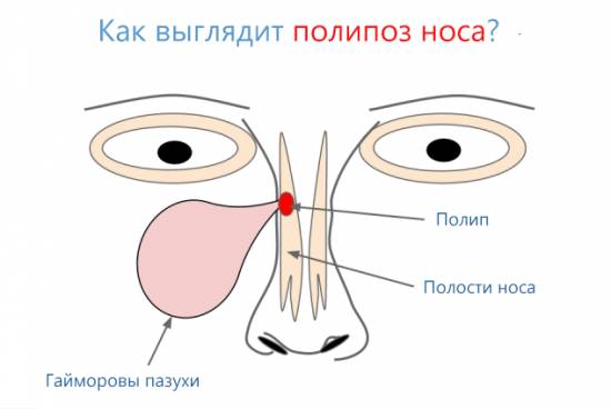 Поліпоз носа і навколоносових пазух: симптоми і лікування