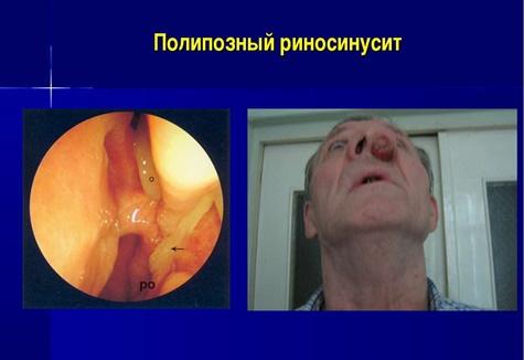 Поліпозний риносинусит. Клінічні рекомендації.