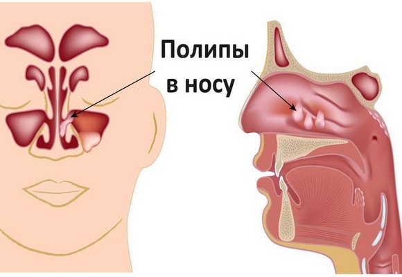 Поліпозний риносинусит – причини, симптоми, лікування