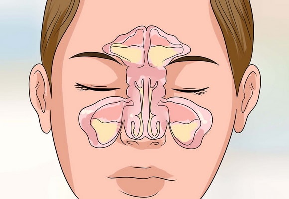 Поліпозний риносинусит – причини, симптоми, лікування