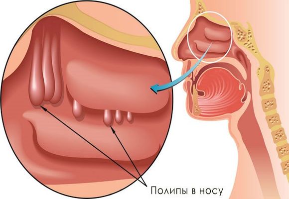 поліпозний Синусит. Причини, симптоми і лікування полипозного і кістозного синуситу