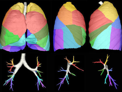 Полисегментарная пневмонія у дорослих: двостороння, лівостороння Полисегментарная пневмонія у дорослих: двостороння, лівостороння