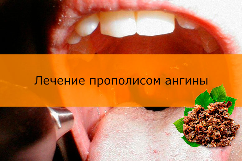 Полоскання настоянкою прополісу від ангіни