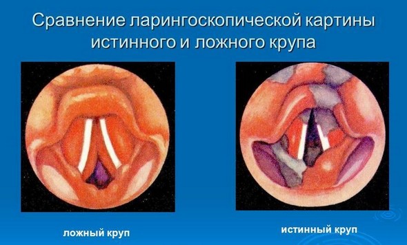 Помилковий круп – причини, ознаки, симптоми і лікування