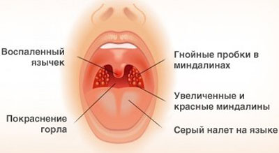 Поради щодо проведення інгаляцій з хлоргексидином