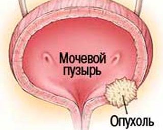 Поширені операції при захворюваннях сечового міхура