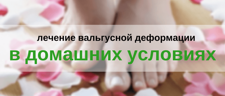 Прибрати кісточку на нозі без операції: лікування шишок