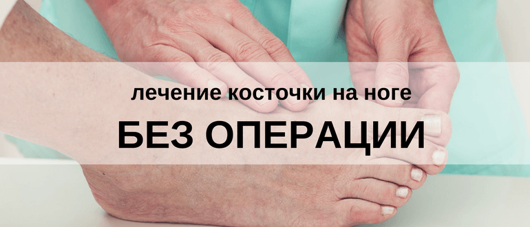Прибрати кісточку на нозі без операції: лікування шишок