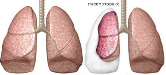 Причини болю в грудній клітці і важкого дихання. Які причини болю в грудній клітці зліва при диханні (вдиху, видиху), при русі тілом? Коли вдихаю болить грудна клітка
