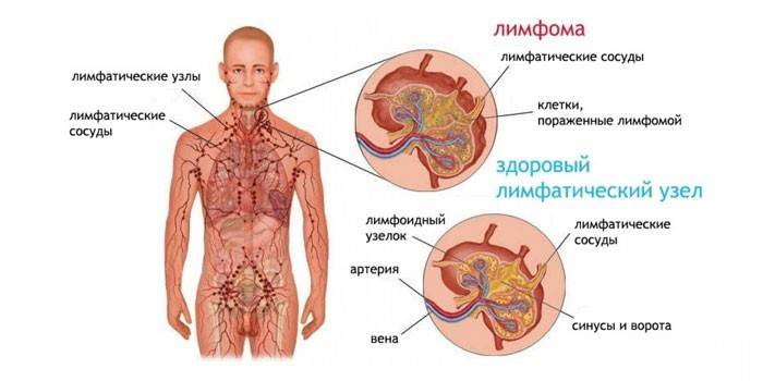 Причини і діагностика лімфоаденопатія вузлів шиї у дітей і дорослих