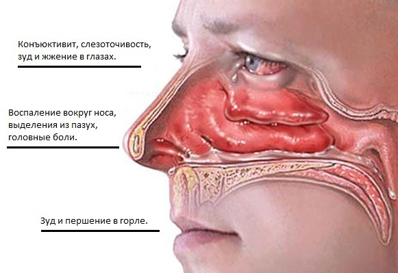 Причини хронічного нежитю і лікування хронічного риніту