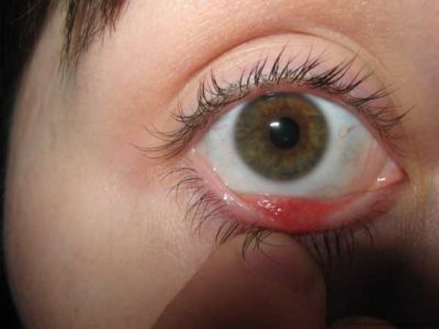 Причини і лікування болю в куточку ока ближче до носа