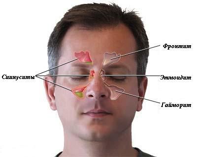 Причини і лікування гострого фронтиту