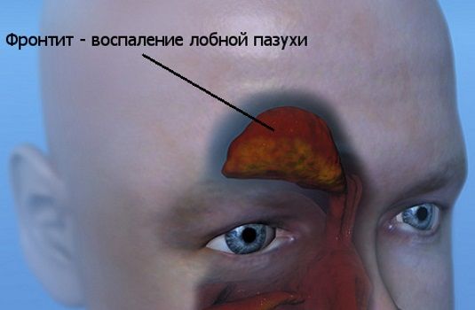 Причини і лікування гострого фронтиту