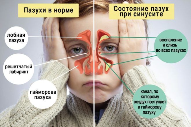 Причини і лікування сухого кашлю