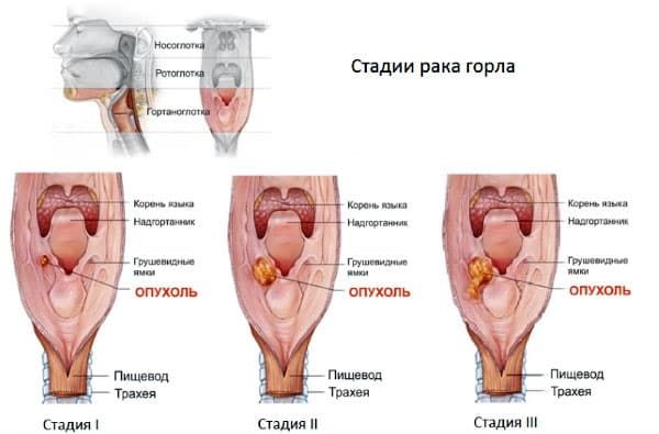 Причини і лікування сухого кашлю