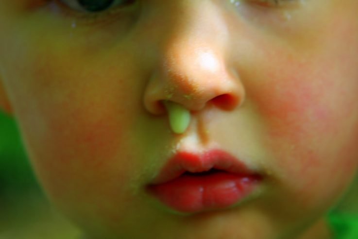 Причини і лікування виділень з кров’ю з носа при гаймориті