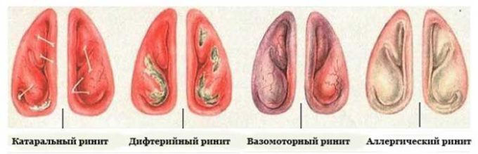 Причини і методи лікування постійного нежитю. Причини постійного нежитю та способи його лікування